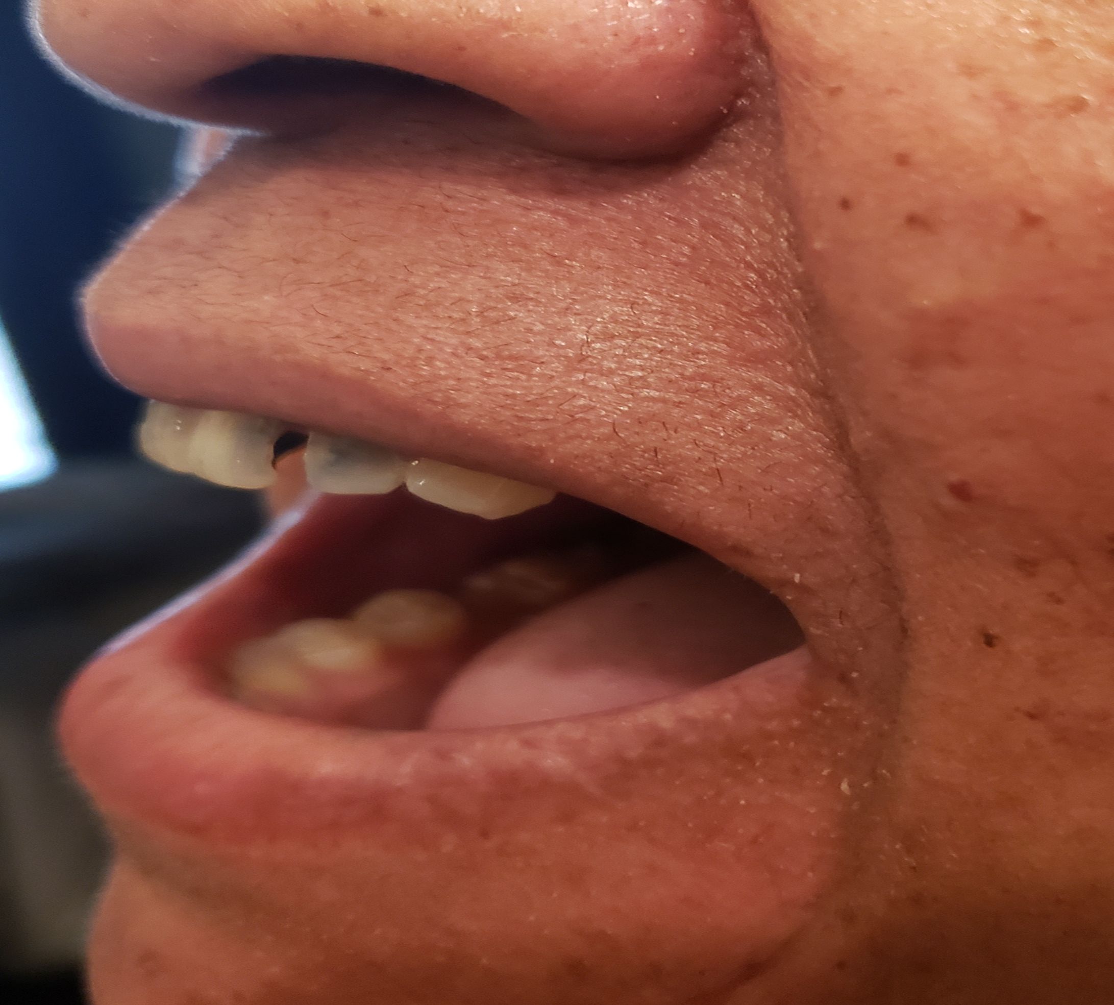 mouth left side