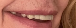 mouth right side