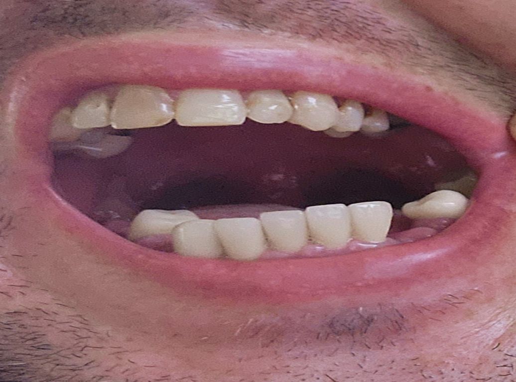 mouth left side