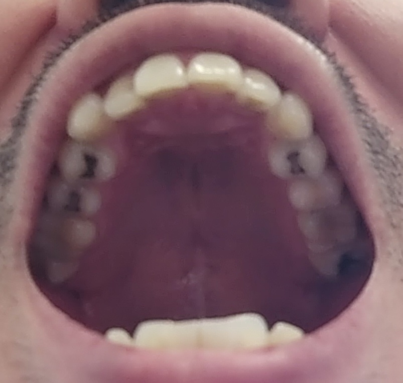 mouth upper arch