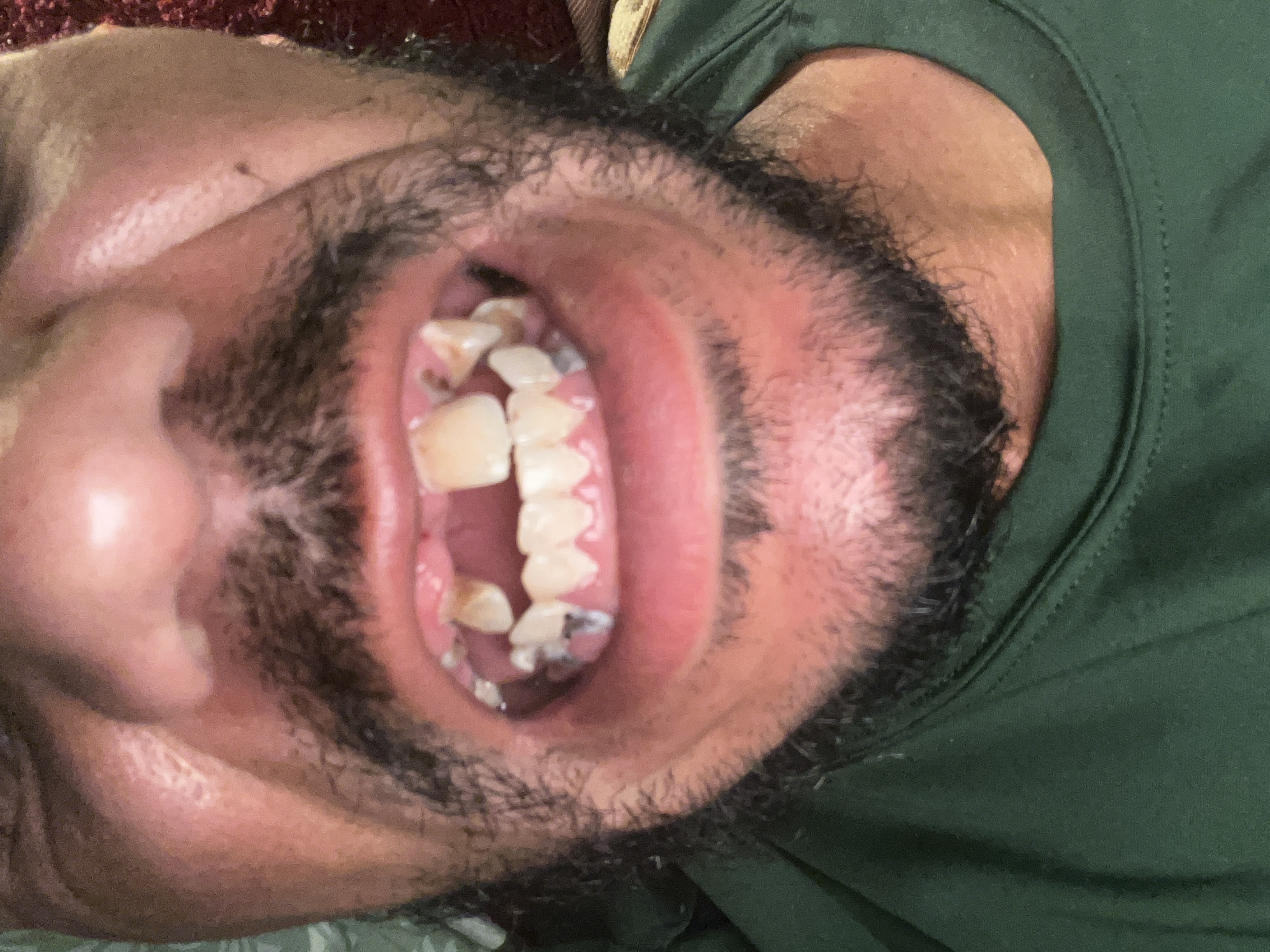 Teeth front
