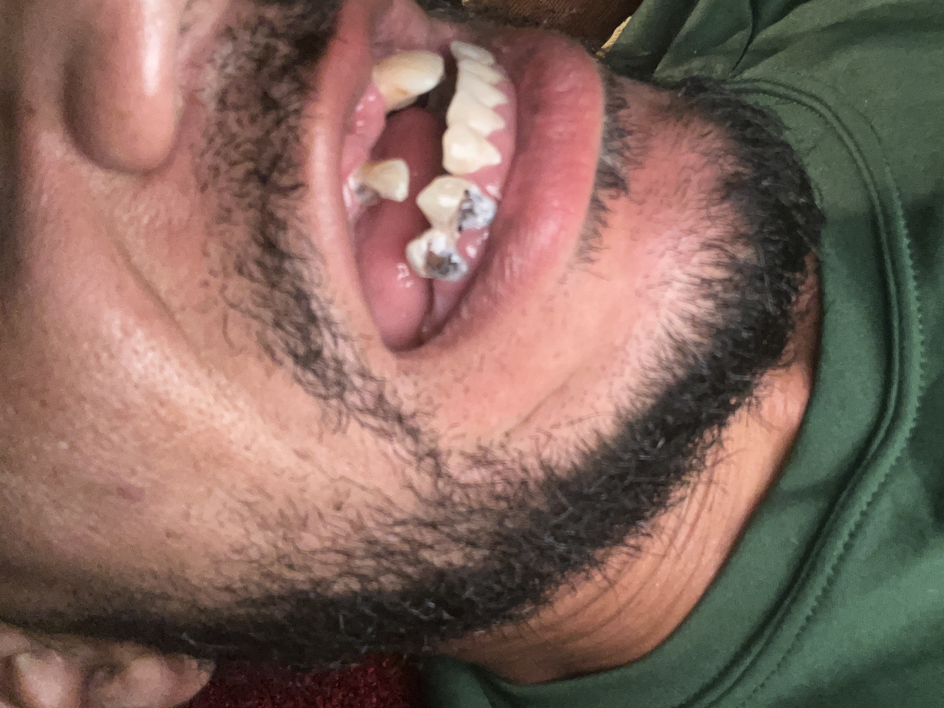 mouth right side