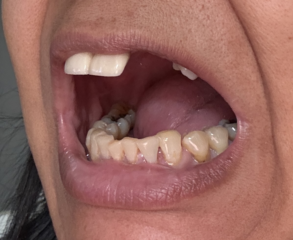 mouth right side